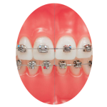 braces-circulo